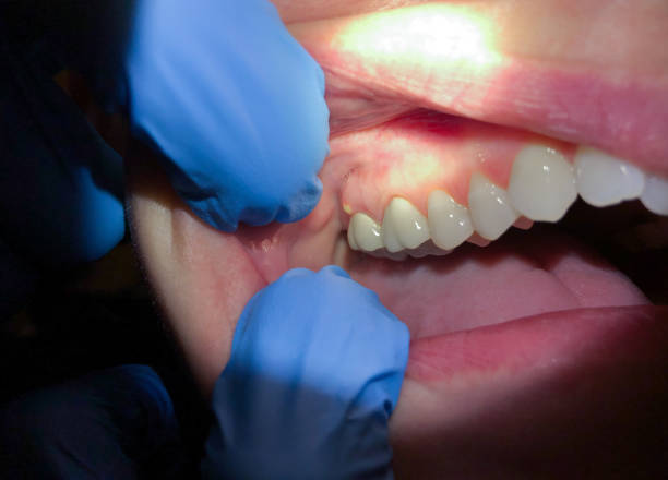 Best Knocked-Out Tooth (Avulsed Tooth) Treatment in Franklin, CA
